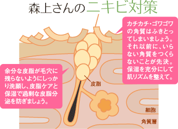森上さんのニキビ対策