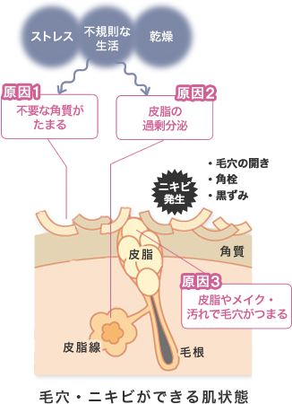 ストレス・不規則な生活・乾燥 原因1不要な角質がたまる 原因2皮脂の過剰分泌 原因3皮脂やメイク・汚れで毛穴がつまる ニキビ発生・毛穴の開き・角栓・黒ずみ 毛穴・ニキビができる肌状態