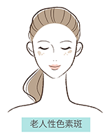 老人性色素斑